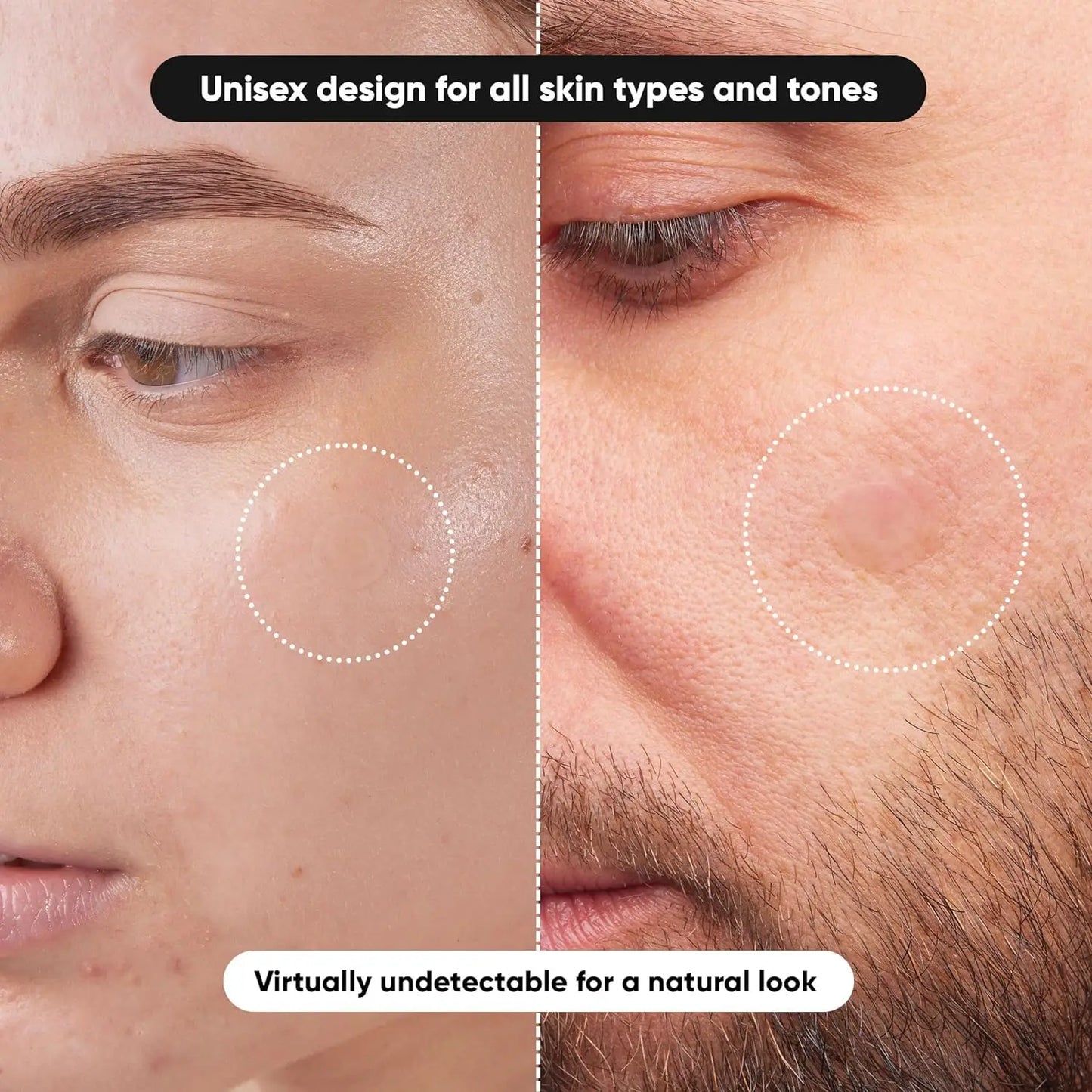720PCS Tea Tree Oil Acne Patches With Salicylic Acid, Invisible Waterproof Acne Stickers For All Skin Types, No Fragrance, Alcoh